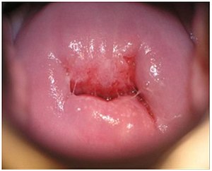 Нормальная шейка матки