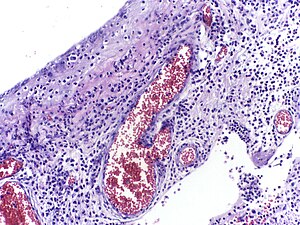 Острый воспалительный экссуда