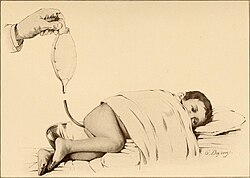 Постановка очистительной клизмы ребёнку, книга 1910 года