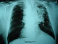 Рак лёгких на рентгеновском снимке