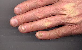 Onycholysis left hand 34yo male ring and little fingers non-fungal.jpg