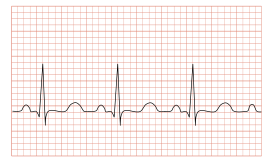 Tachycardia ECG paper.svg