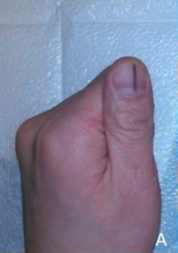 Longitudinal melanonychia.png