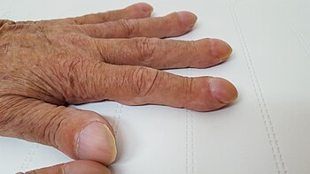 Clubbing fingers 2.jpg