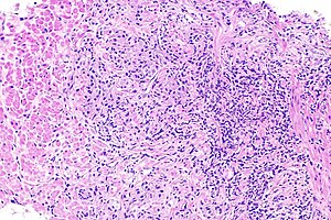 Карцинома предстательной железы с воспалением