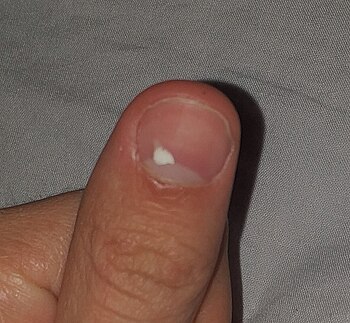 Leucomiquia, una uña con una mancha de gran tamaño.jpg