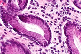 Chronic gastritis -- very high mag.jpg