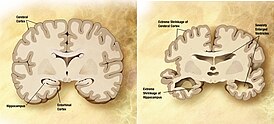 Мозг пожилого человека в норме (слева) и при патологии, вызванной болезнью Альцгеймера (справа), с указанием отличий.