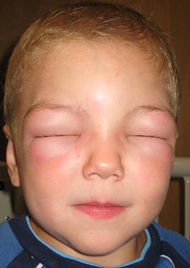 Angioedema2010.JPG