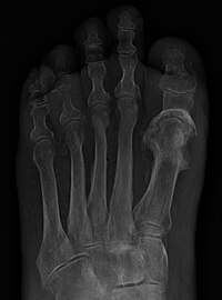 Osteomyelitis of the 1st MTP.jpg