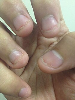 Severe nail and cuticle bitting.jpg