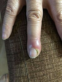 Acute paronychia.jpg